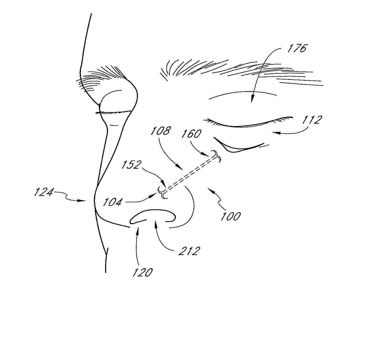 Methods and devices for rhinoplasty and treating internal valve stenosis