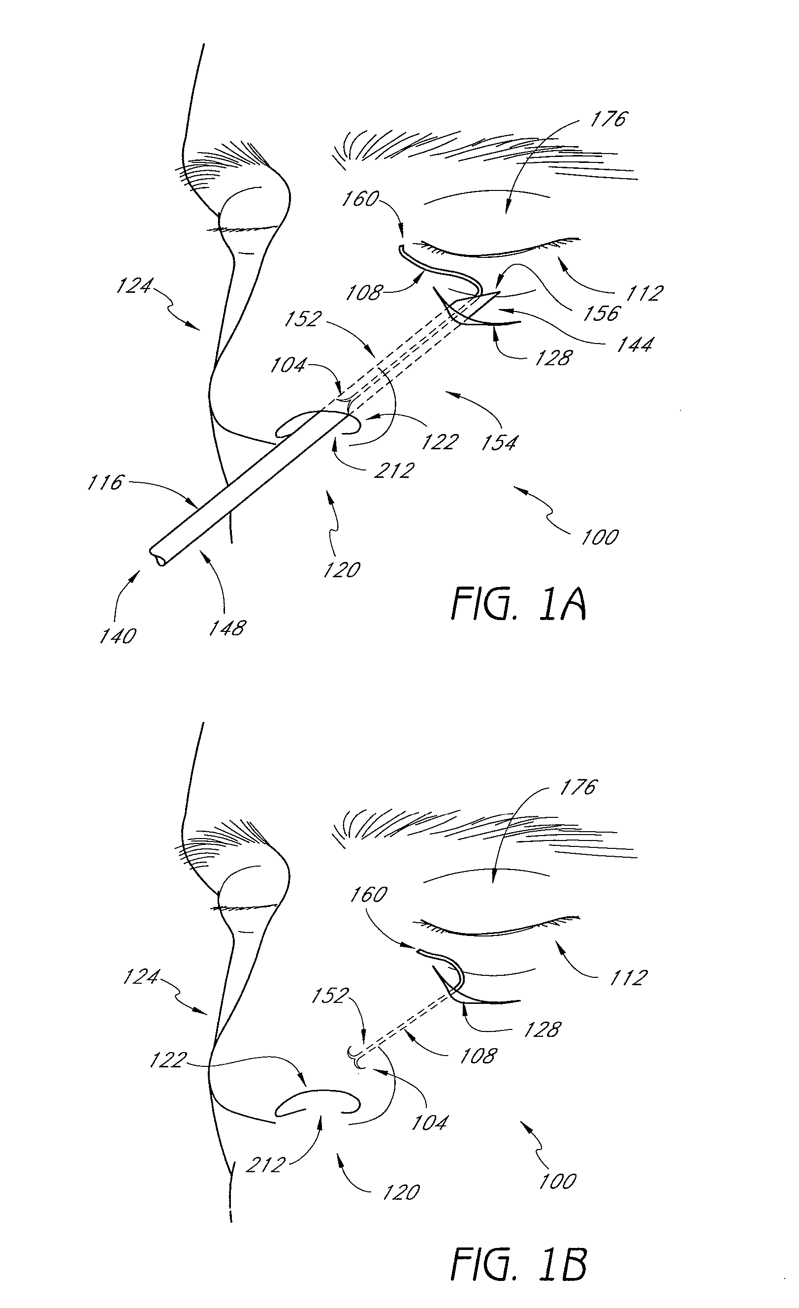 Methods and devices for rhinoplasty and treating internal valve stenosis