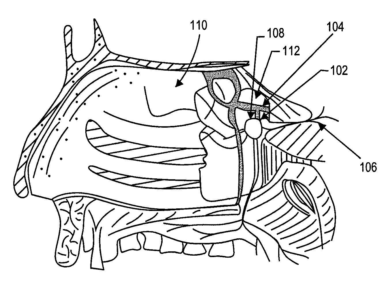 Method and device for the treatment of headache