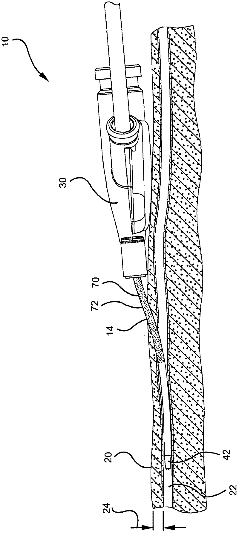 Antimicrobial coating for dermally invasive devices