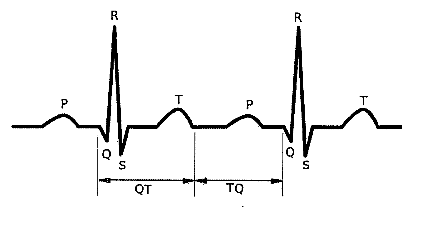 Novel methodology for arrhythmia risk stratification by assessing qt interval instability