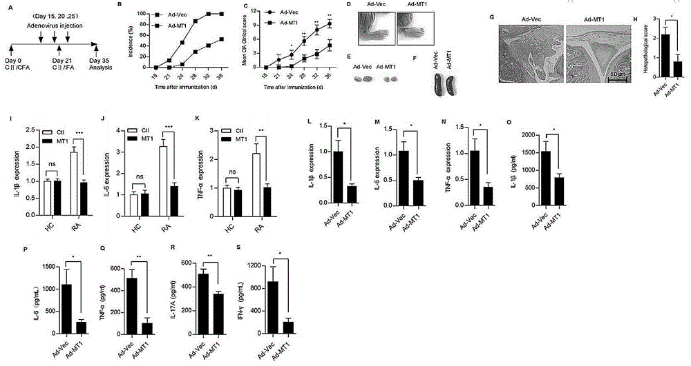 Application of metallothionein-1 in preparation of drugs for inhibiting rheumatoid arthritis