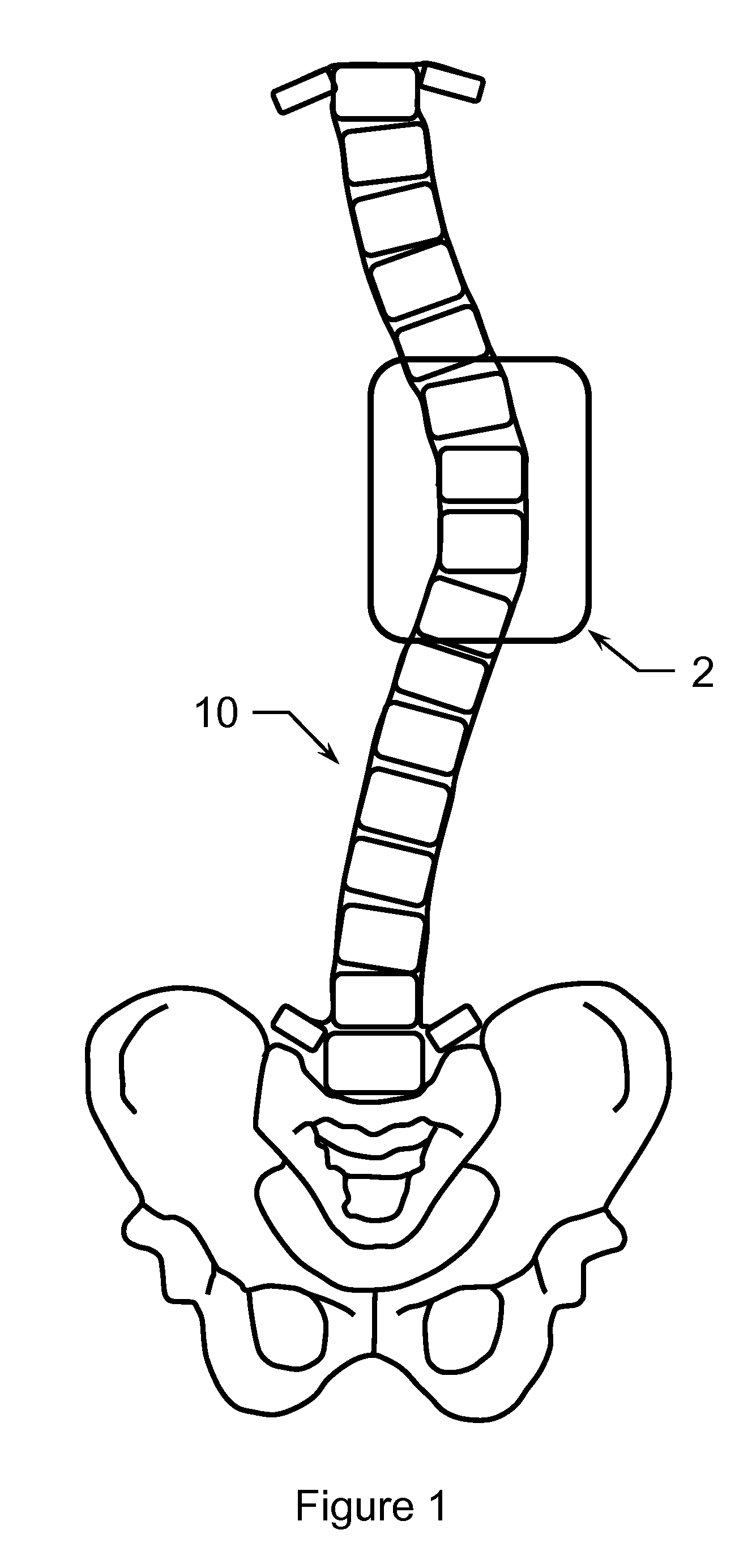 Method of Treating Scoliosis Using a Biological Implant