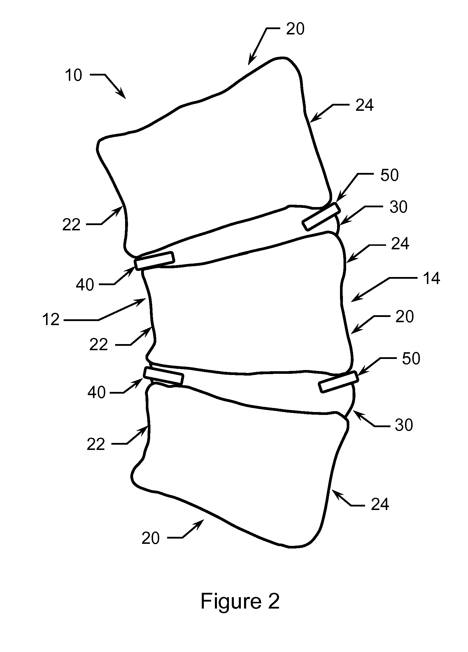 Method of Treating Scoliosis Using a Biological Implant