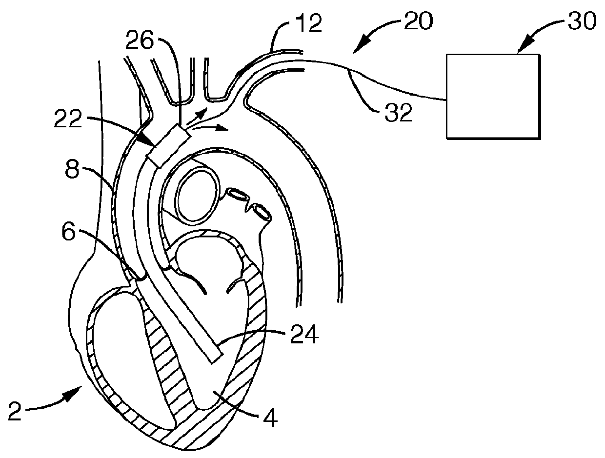 Heart assist device