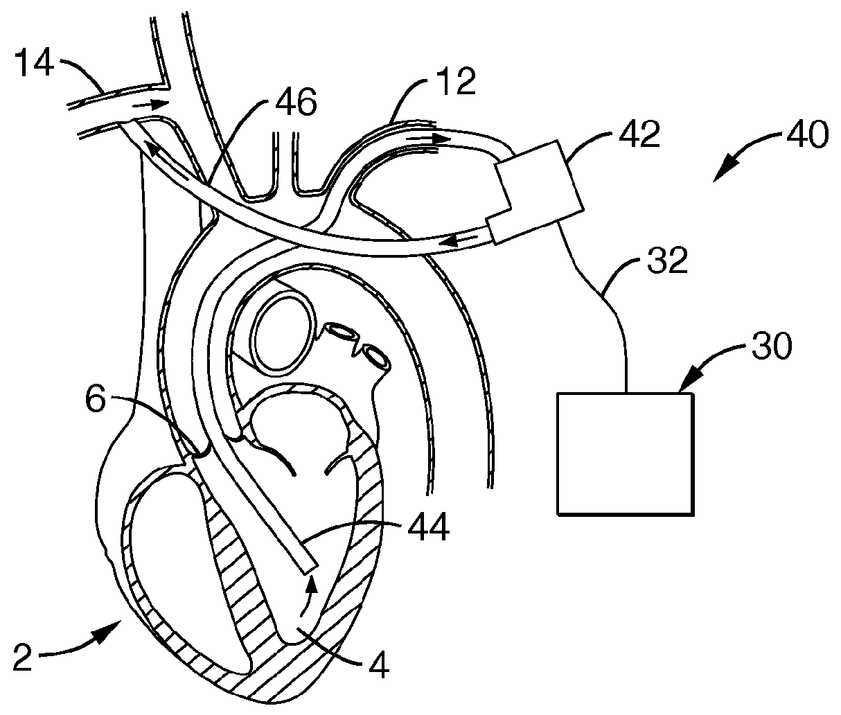 Heart assist device