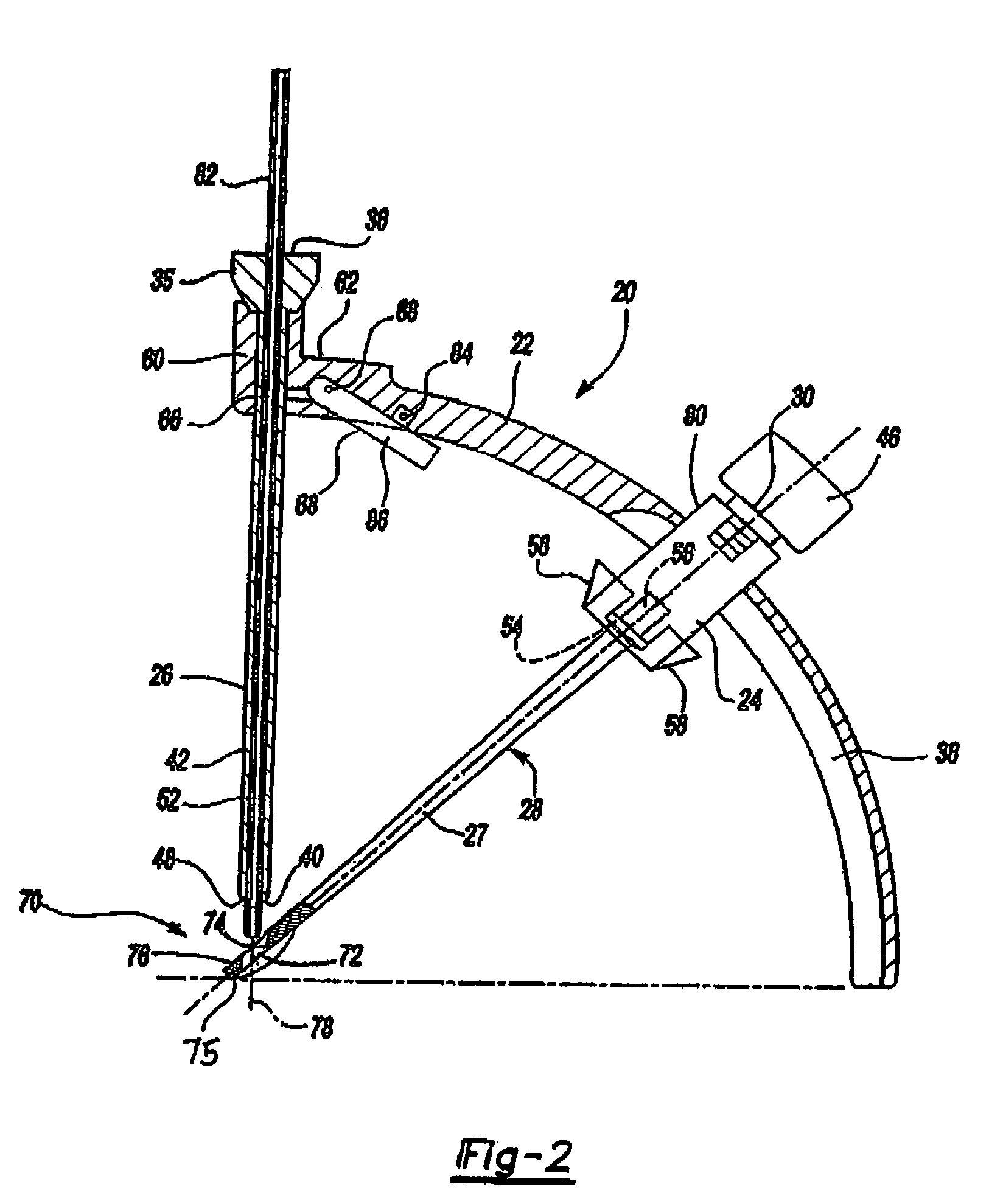 Device and method to assist in arthroscopic repair of detached connective tissue