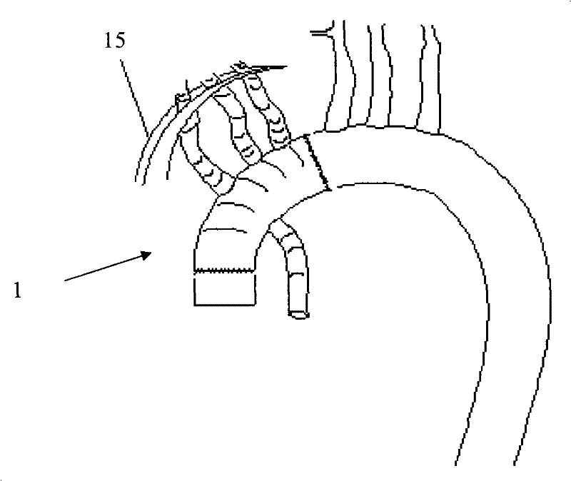 Improved intraoperation stent system