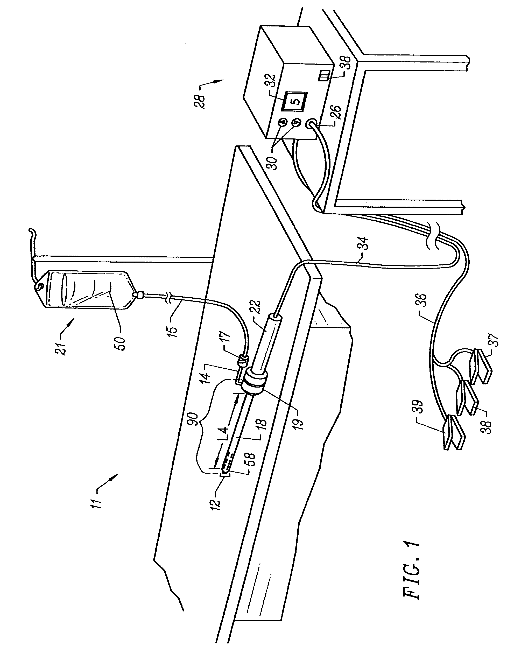 Method for treating obstructive sleep disorder includes removing tissue from base of tongue