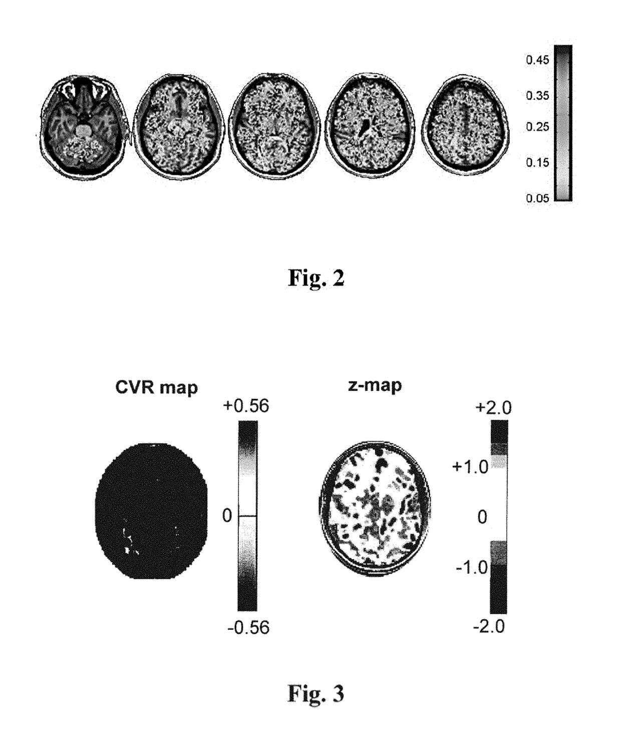 Imaging abnormalities in vascular response