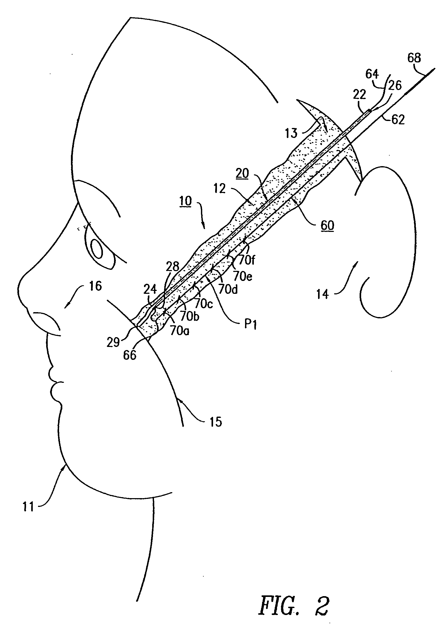 Suture instrument and method of suturing in cosmetic surgery