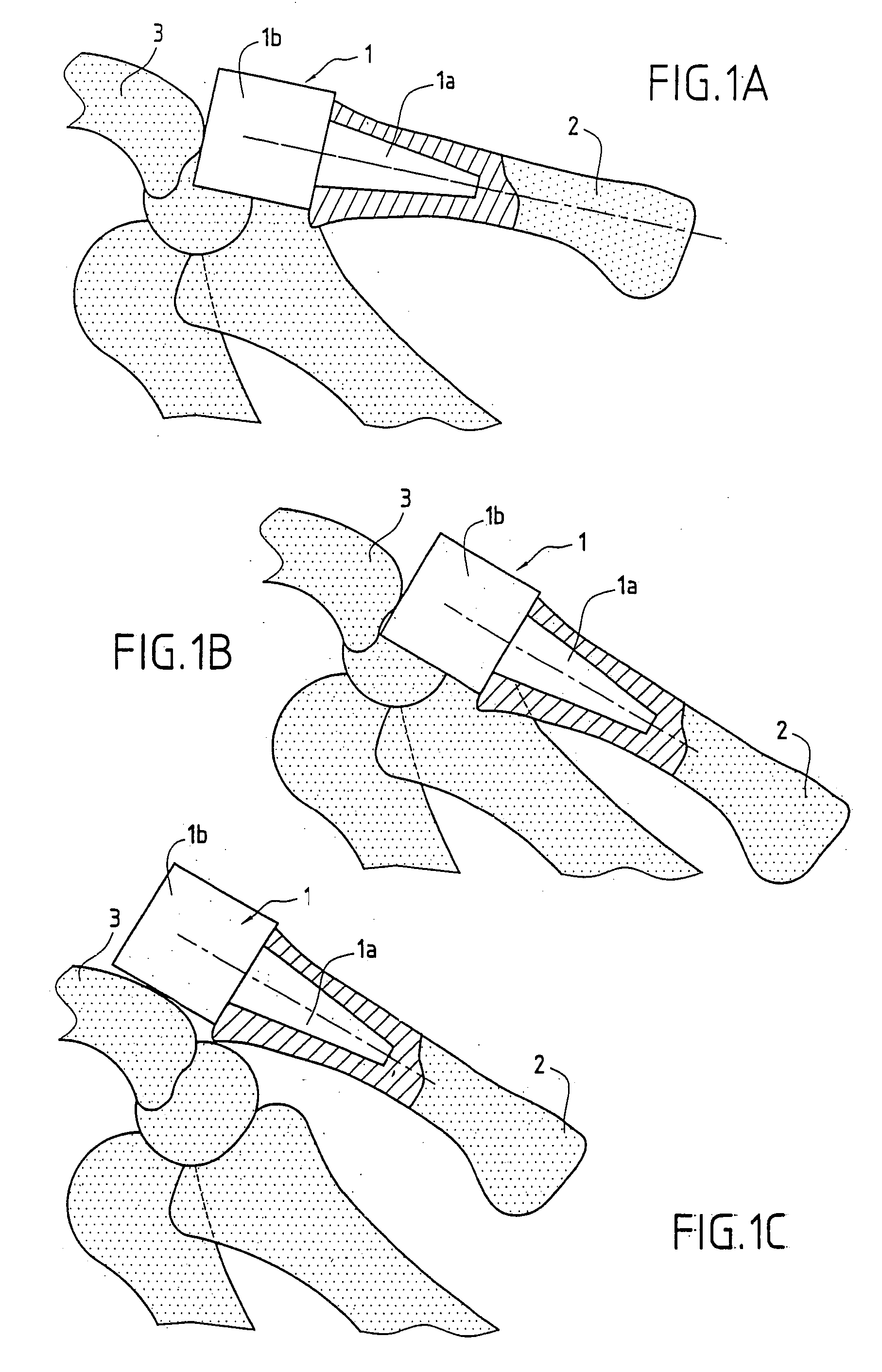 Trapezium or trapezometacarpal implant