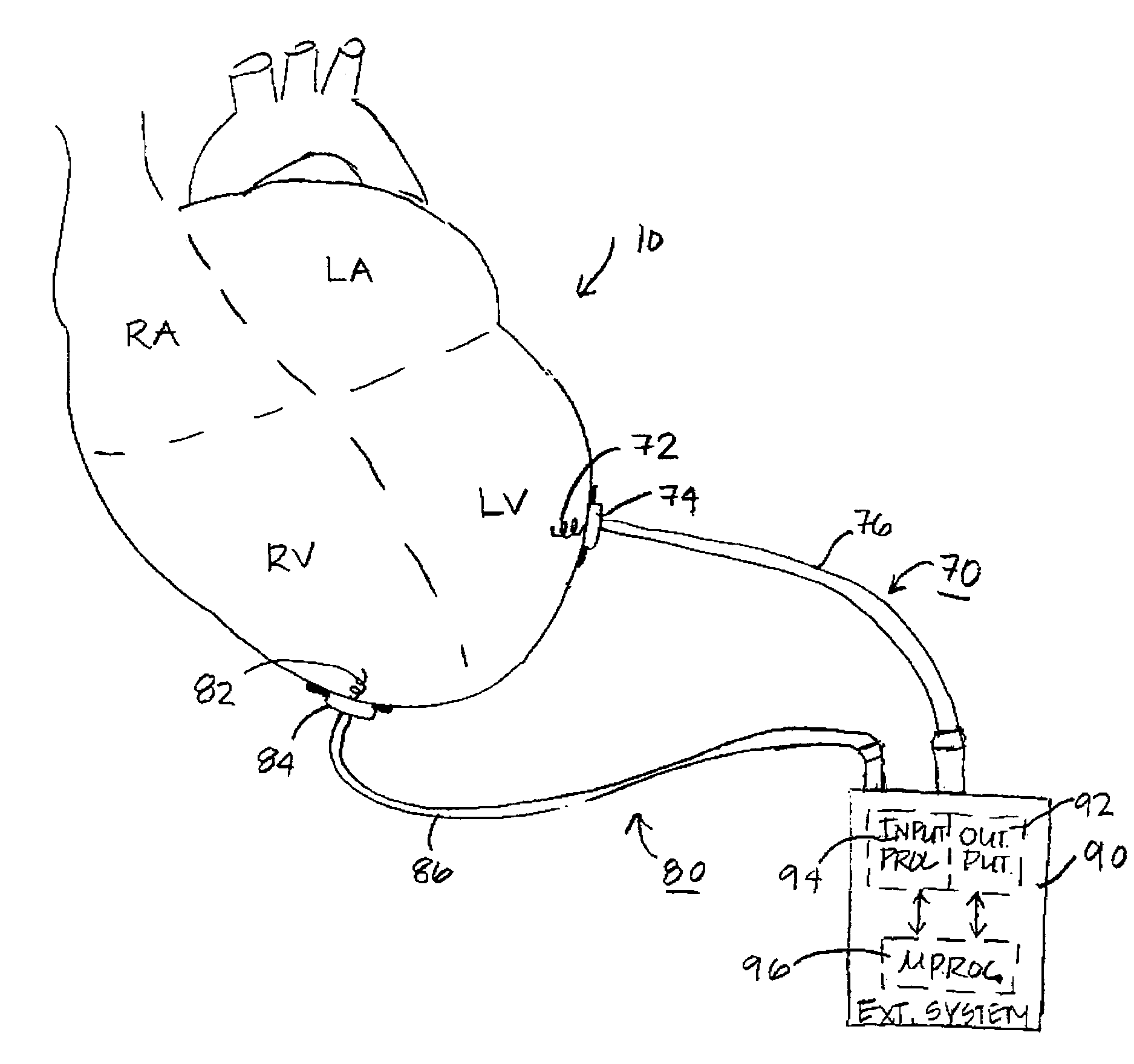 Method and apparatus for assessing left ventricular function and optimizing cardiac pacing intervals based on left ventricular wall motion