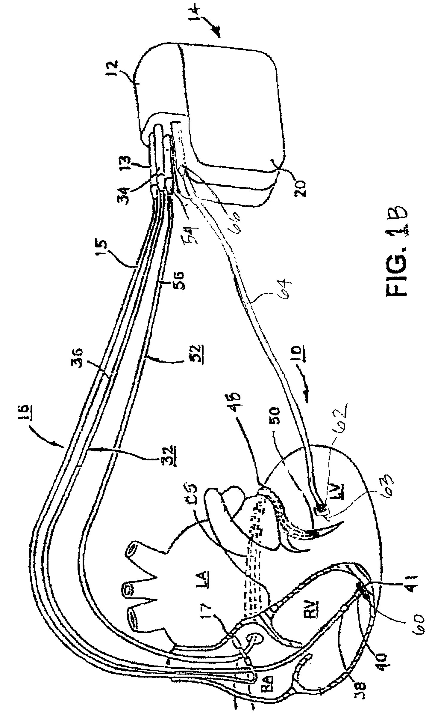 Method and apparatus for assessing left ventricular function and optimizing cardiac pacing intervals based on left ventricular wall motion