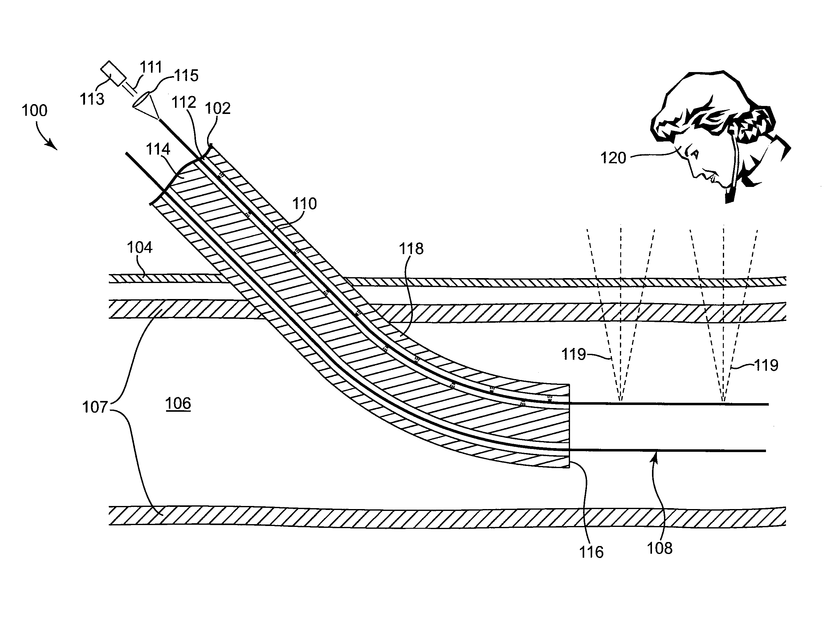 Light-guided transluminal catheter