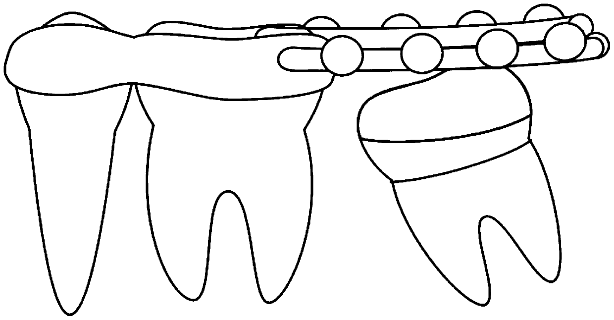 Correcting device and correcting method for traction and straightening of free-end impacted molars