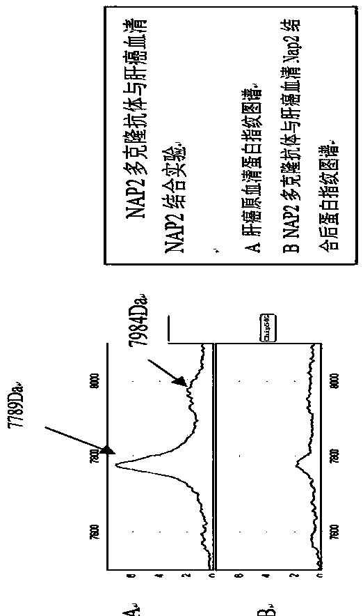 Combination method of NAP2 polyclonal antibody and liver cancer serum NAP2