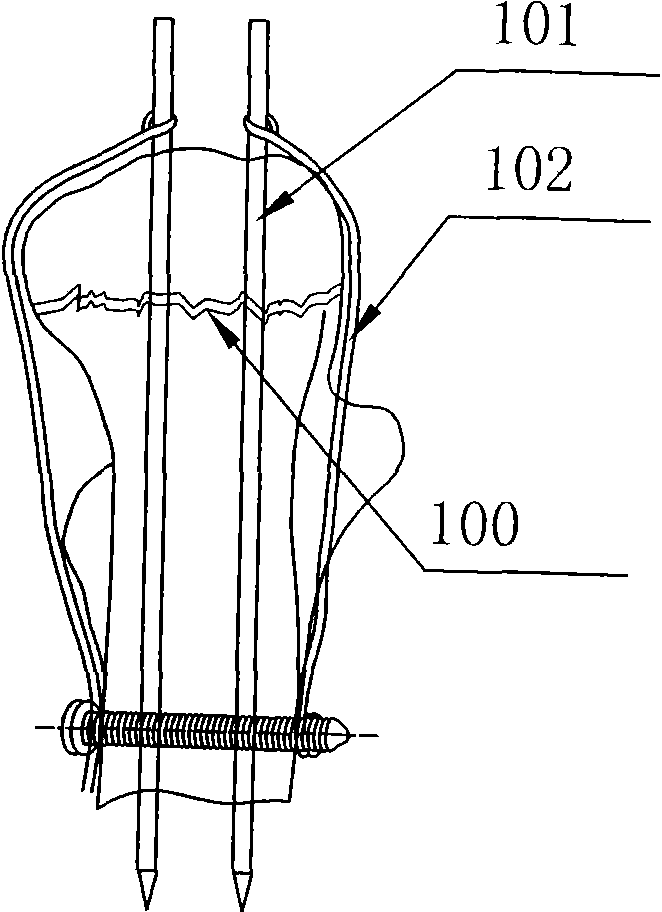 Olecroanon locking proximal humerus plate