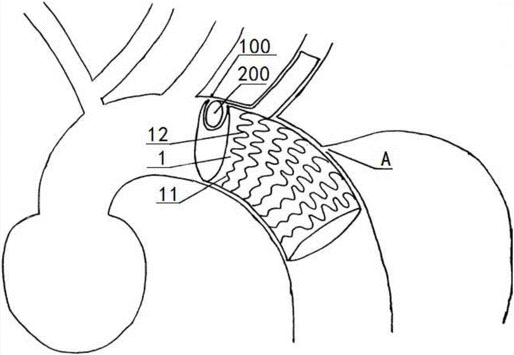 Stent graft