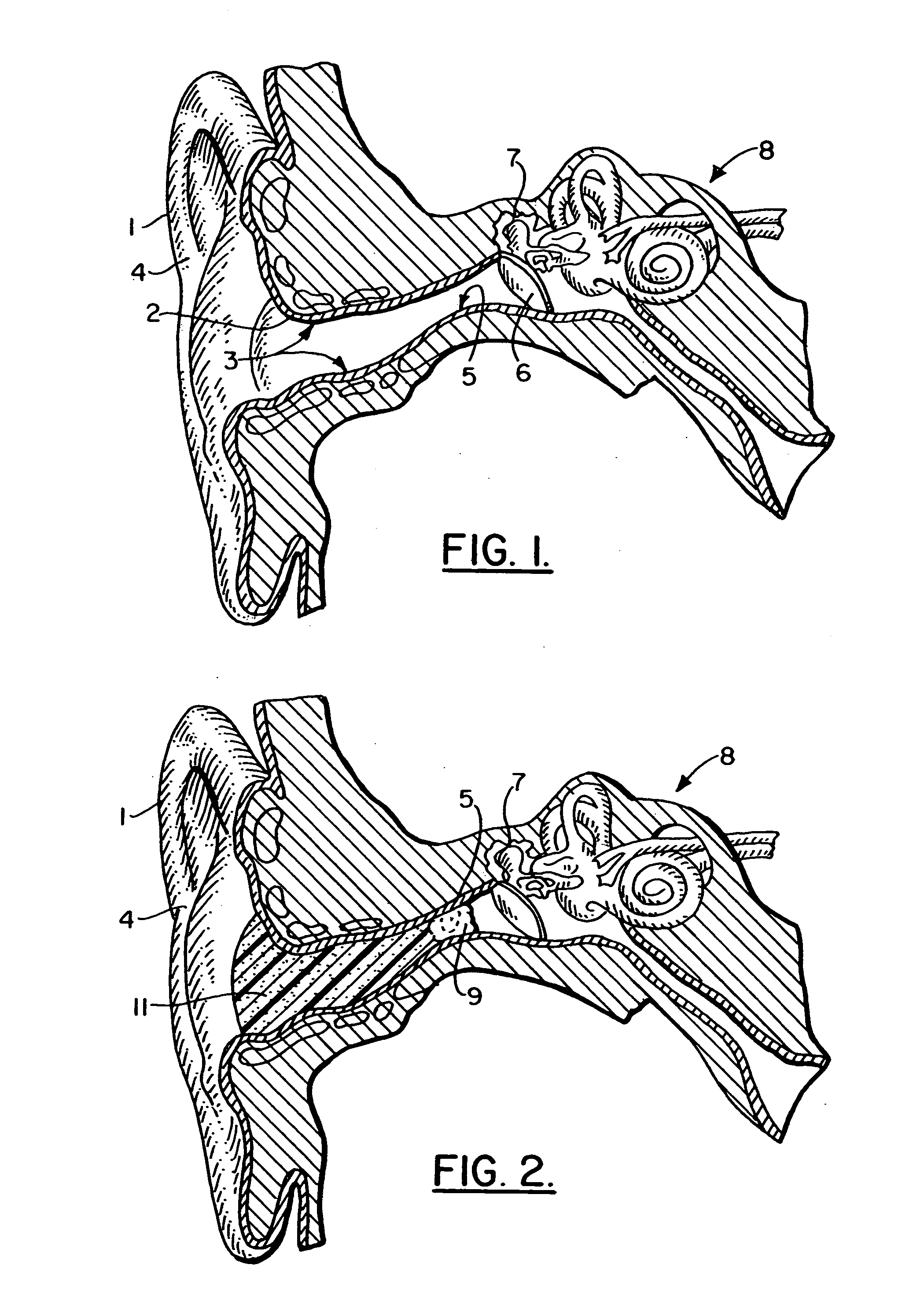 Soft hearing aid with stainless steel wire