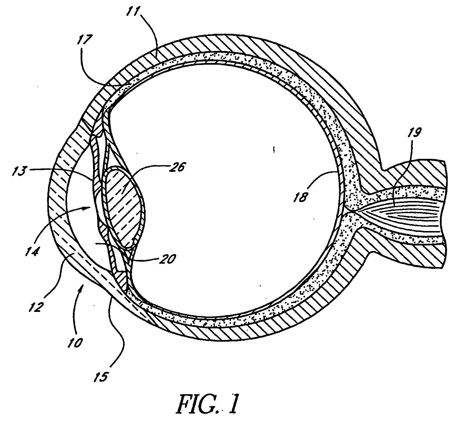 Glaucoma treatment kit