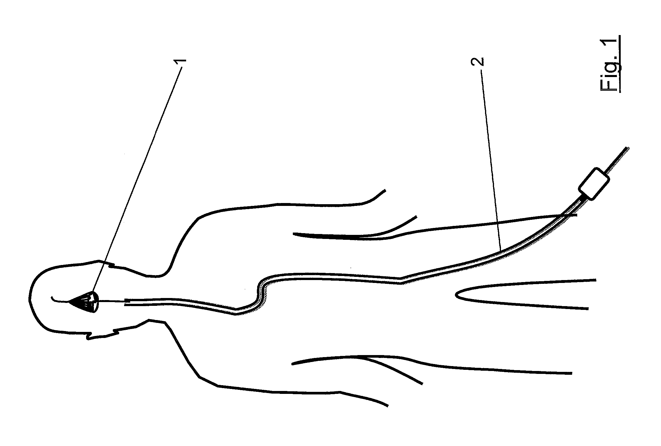 Clot capture systems and associated methods