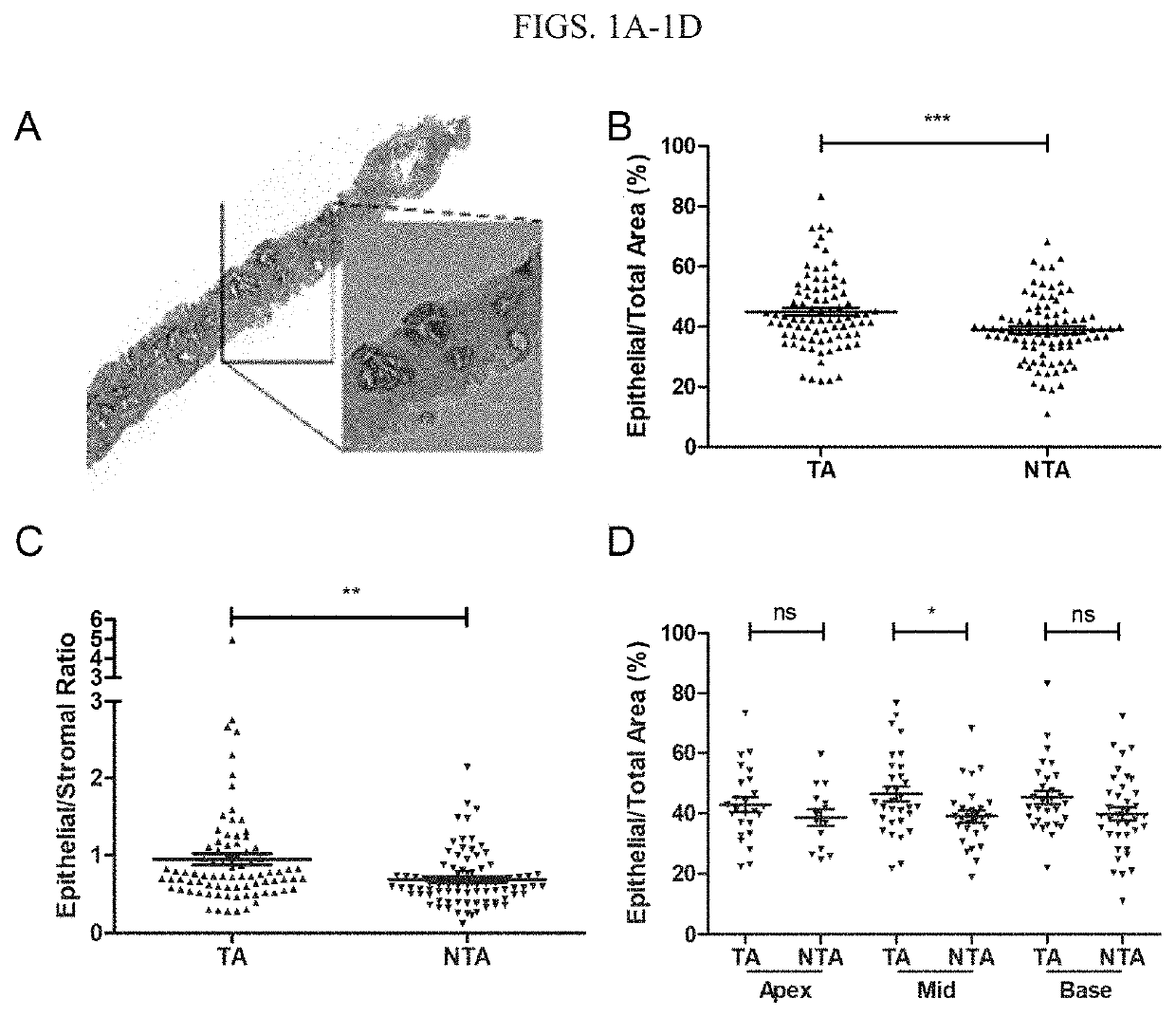 Image analysis of epithelial component of histologically normal prostate biopsies predicts the presence of cancer