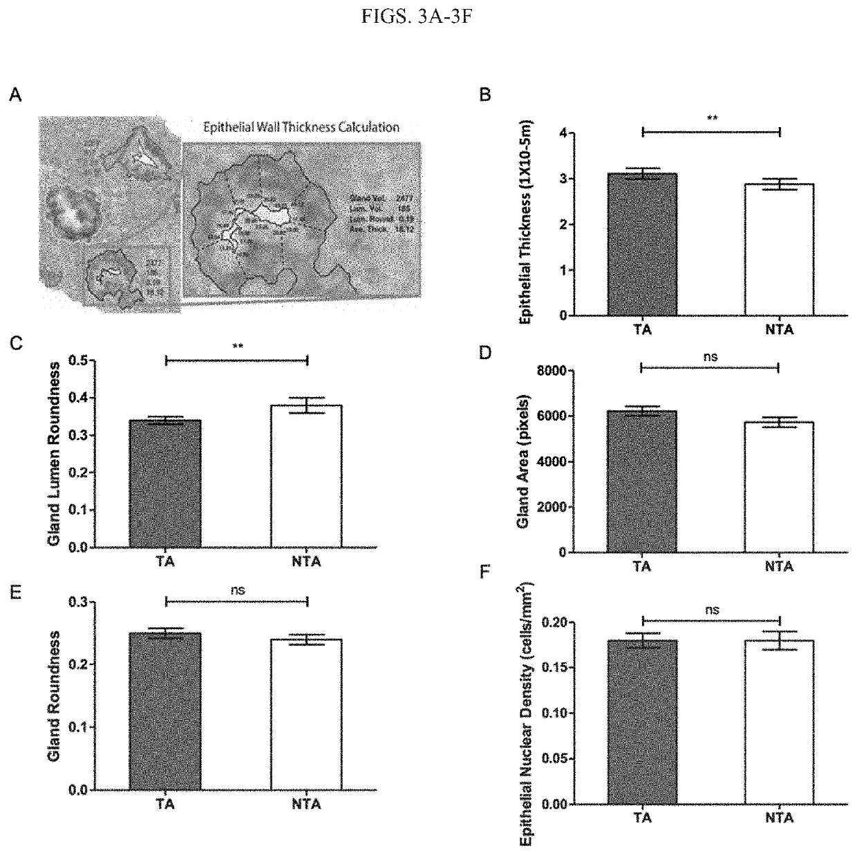 Image analysis of epithelial component of histologically normal prostate biopsies predicts the presence of cancer