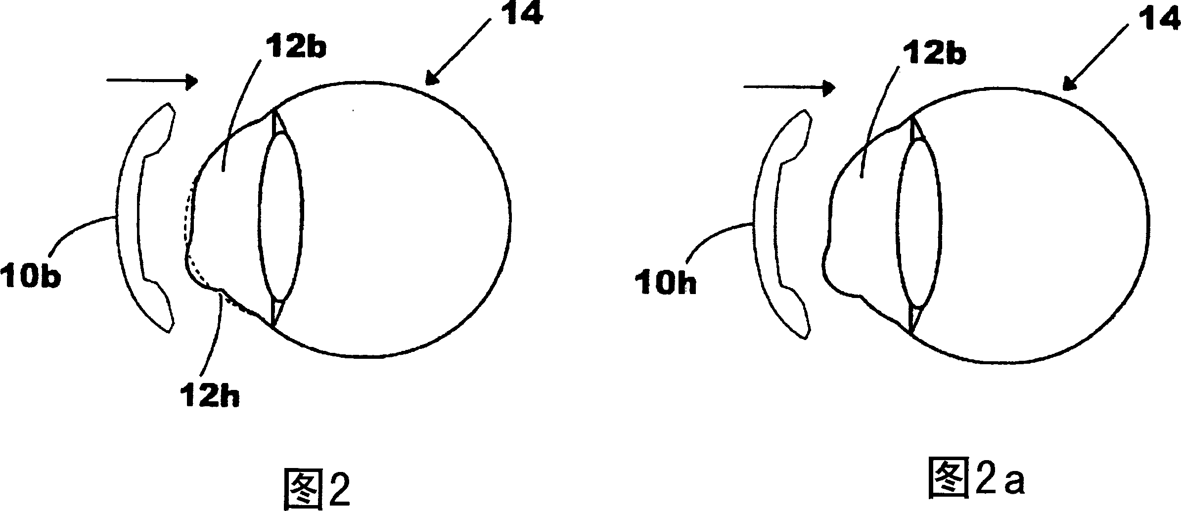 Contact lens for reshaping the altered corneas of post refractive surgery, post ortho-k or keratoconus