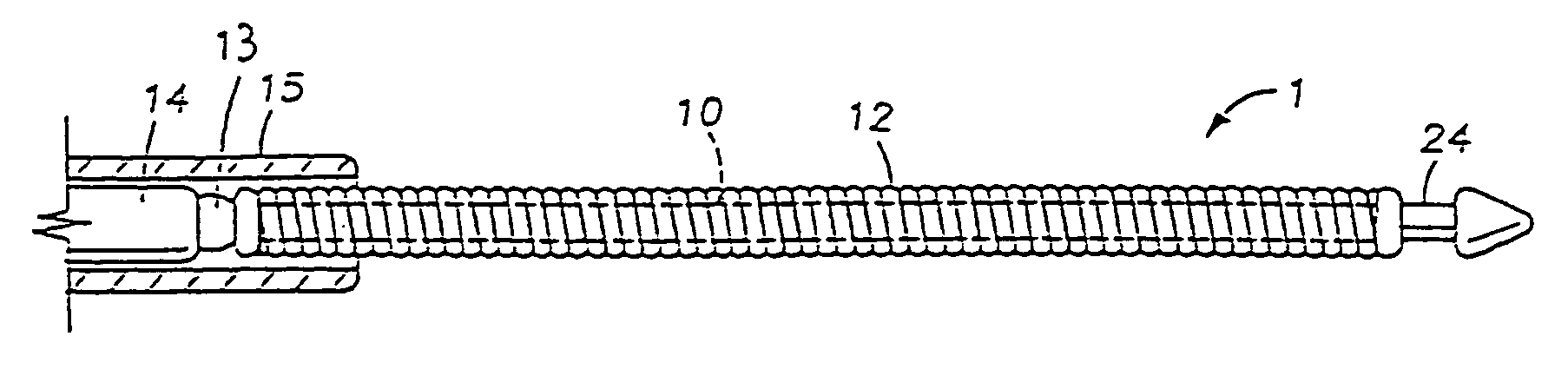 Retrievable, shielded radiotherapy implant