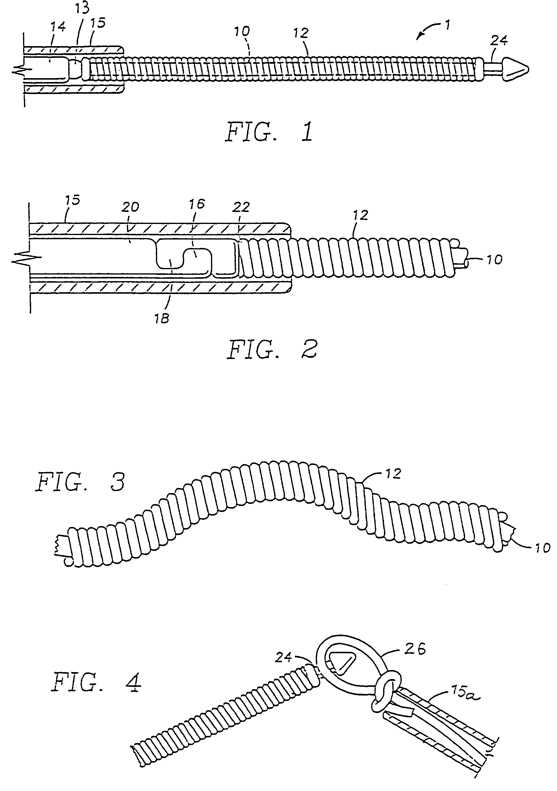 Retrievable, shielded radiotherapy implant