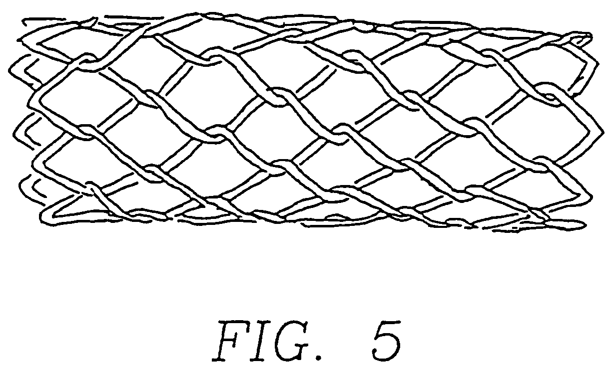 Retrievable, shielded radiotherapy implant