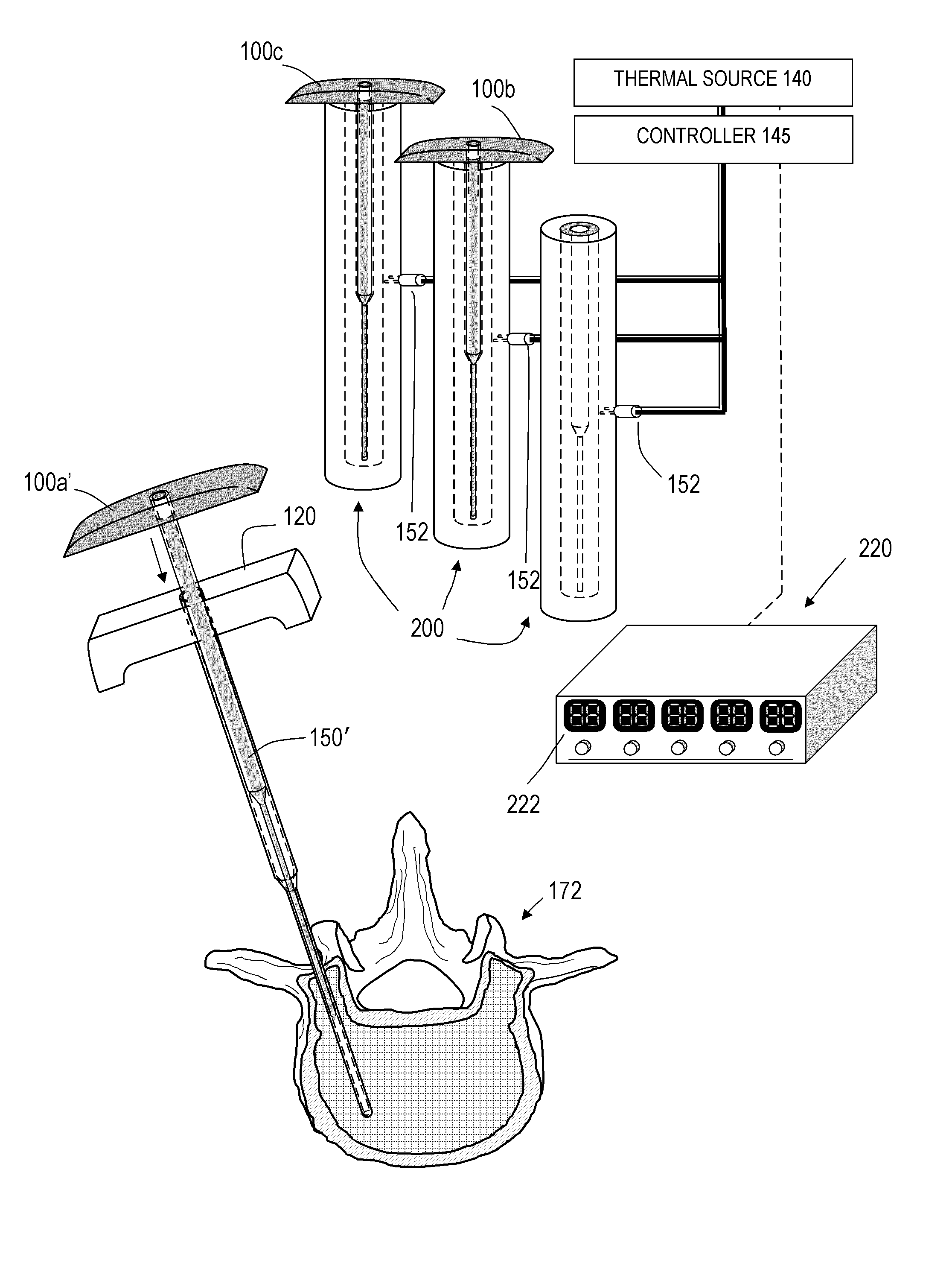 Bone treatment systems and methods