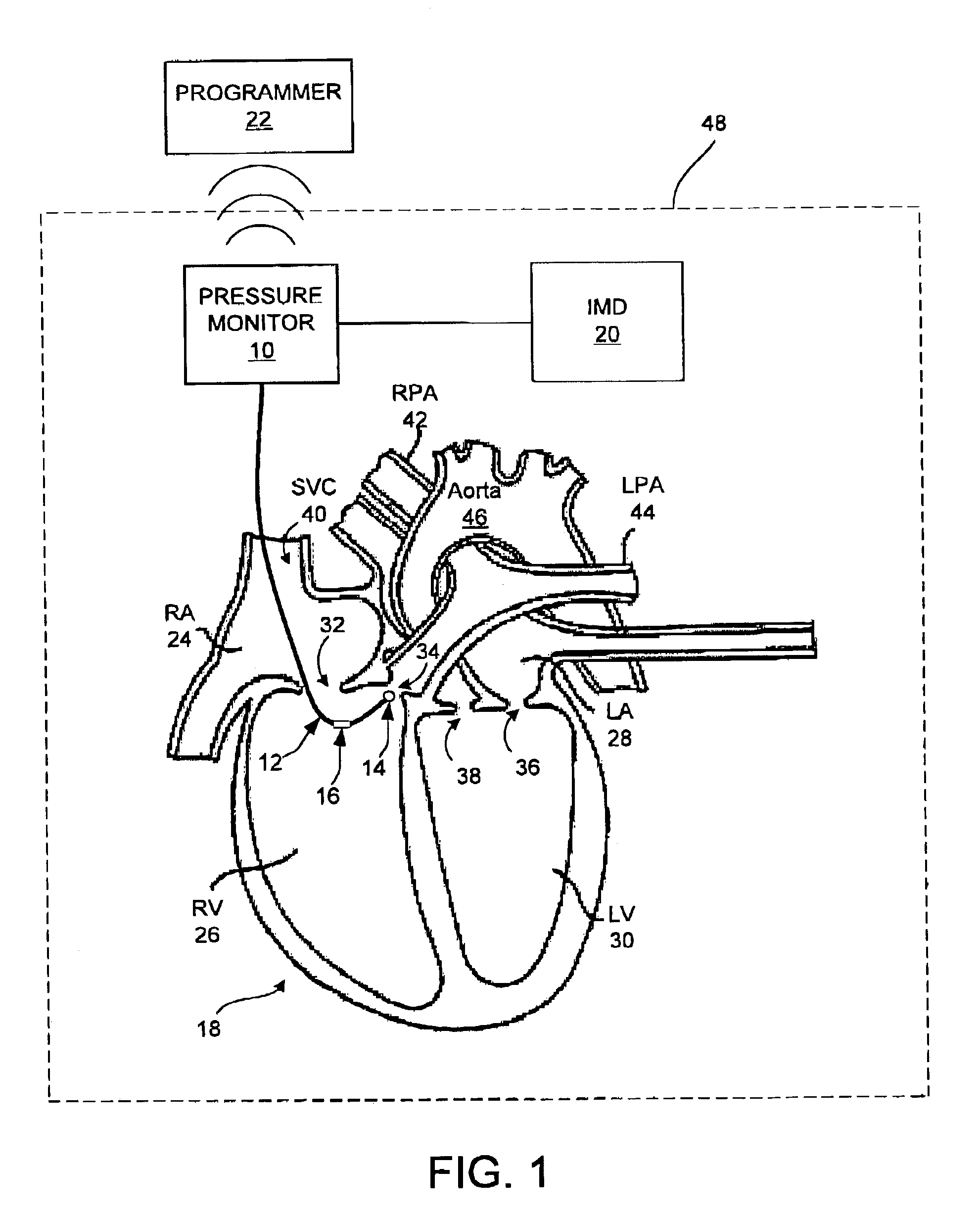 Estimation of stroke volume cardiac output using an intracardiac pressure sensor