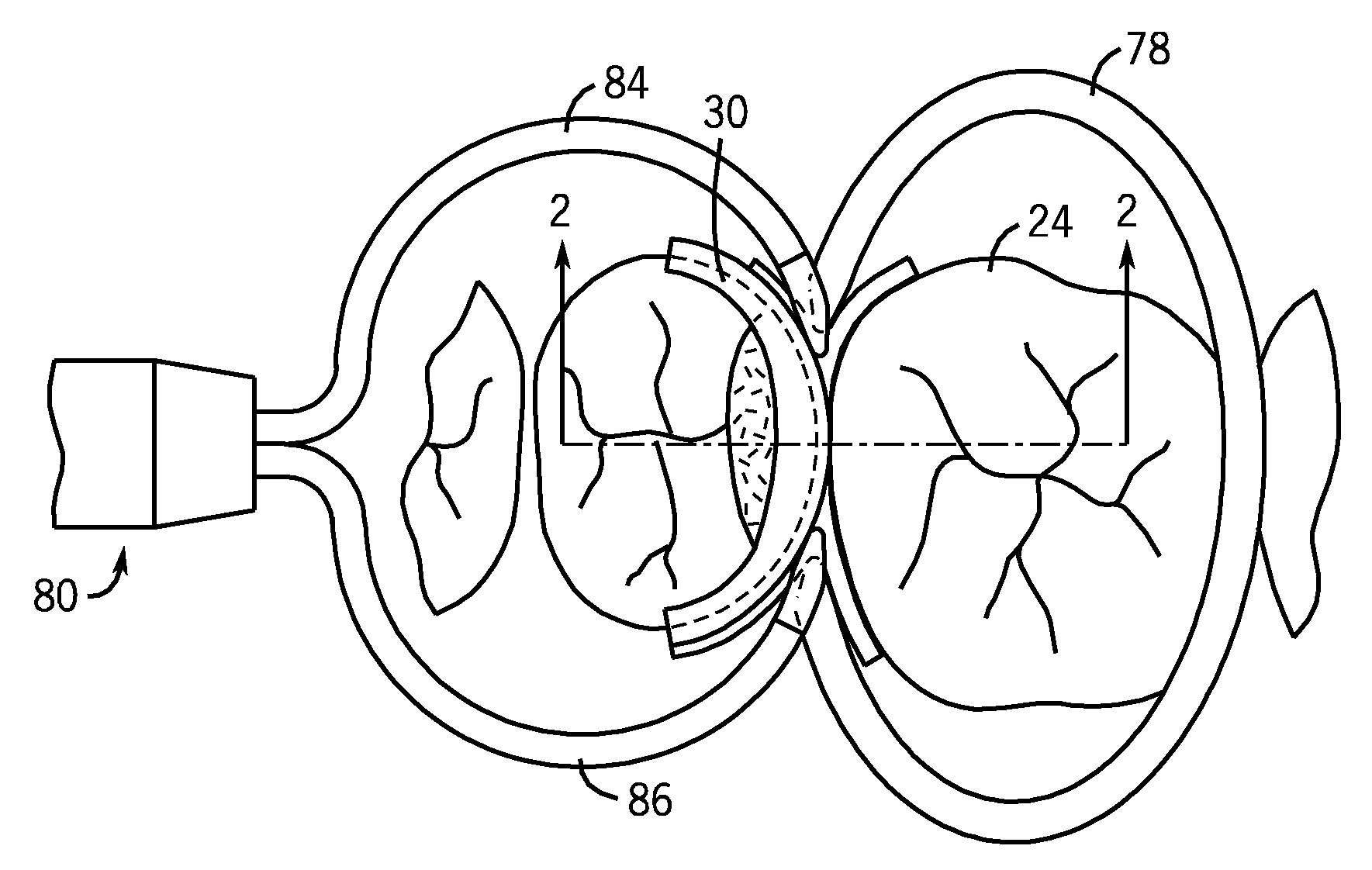 Dental Curing Lights And A Seamless, Single Load Cavity Preparation And Filling Technique