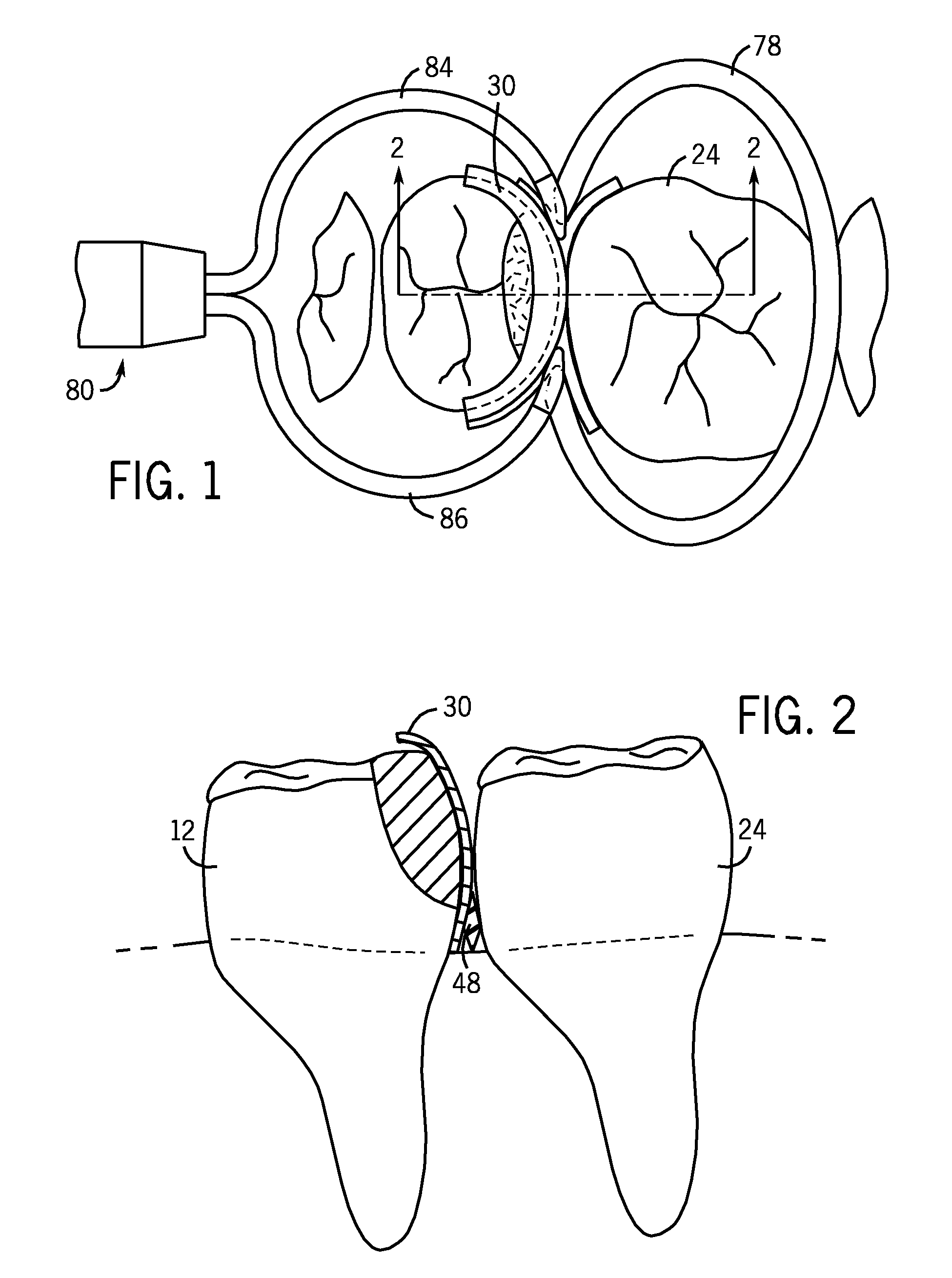 Dental Curing Lights And A Seamless, Single Load Cavity Preparation And Filling Technique