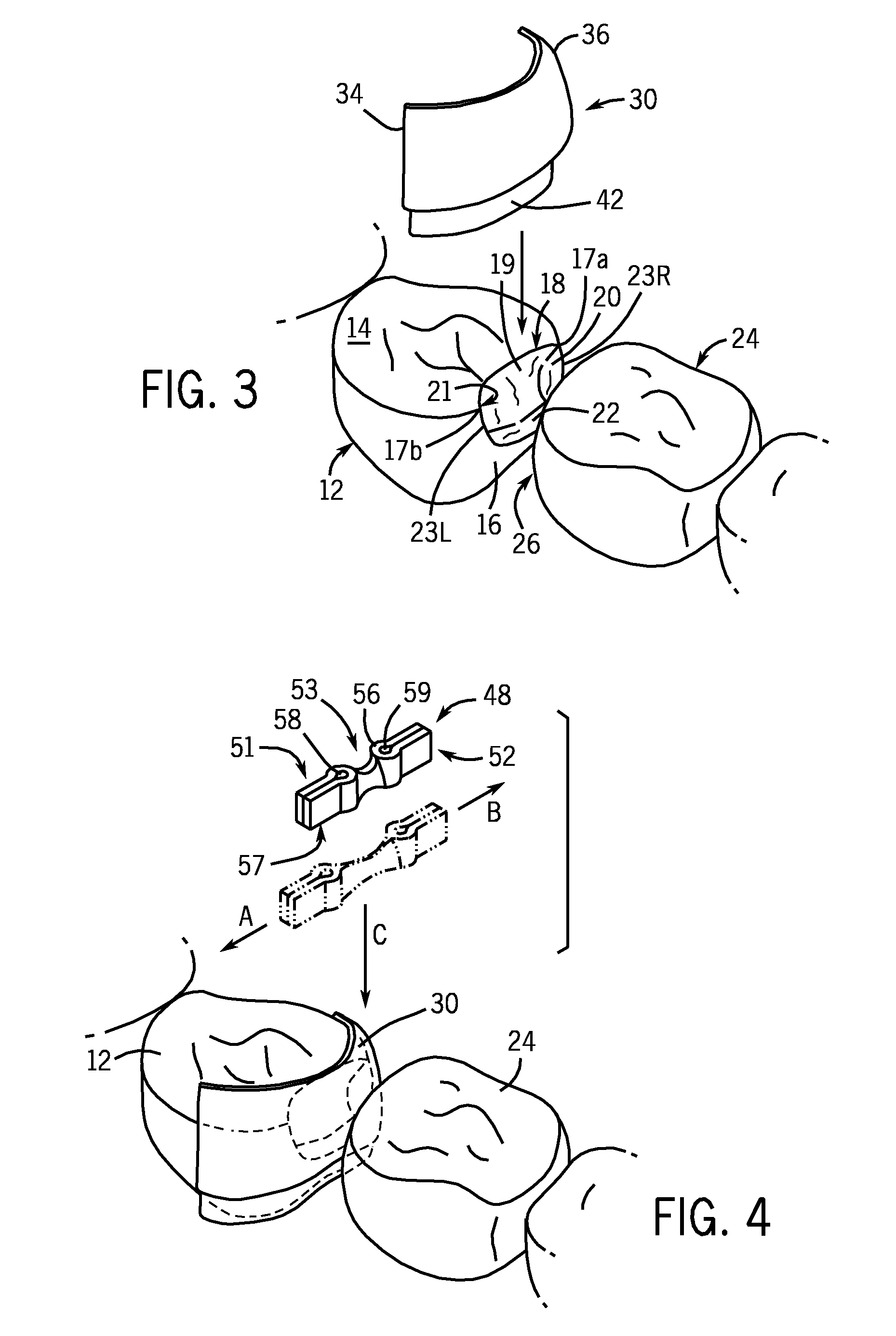 Dental Curing Lights And A Seamless, Single Load Cavity Preparation And Filling Technique