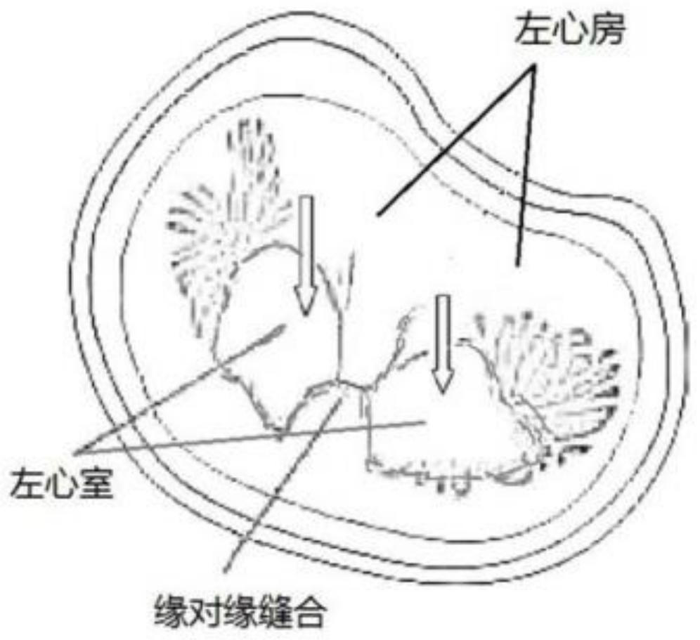 Transcatheter heart valve clamping system