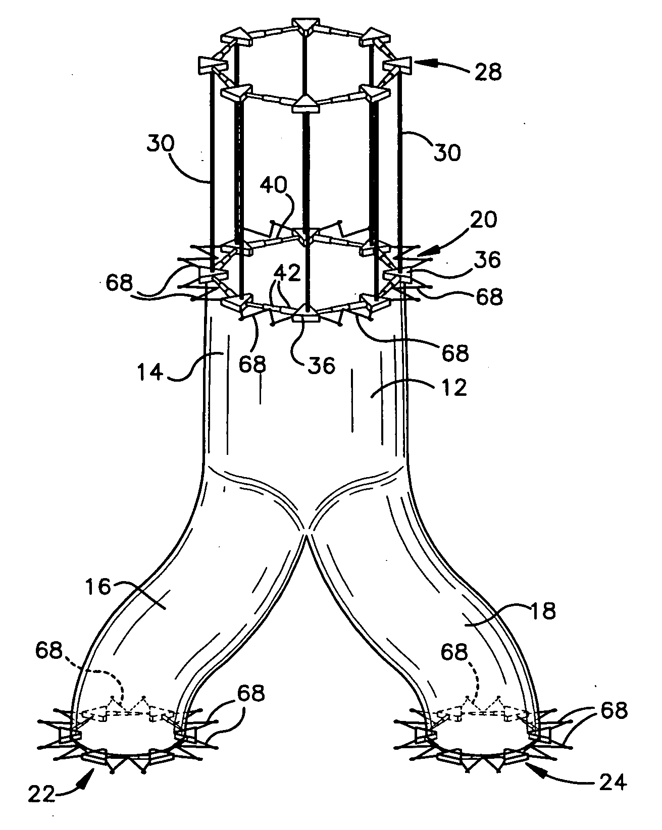 Percutaneous endovascular apparatus for repair of aneurysms and arterial blockages