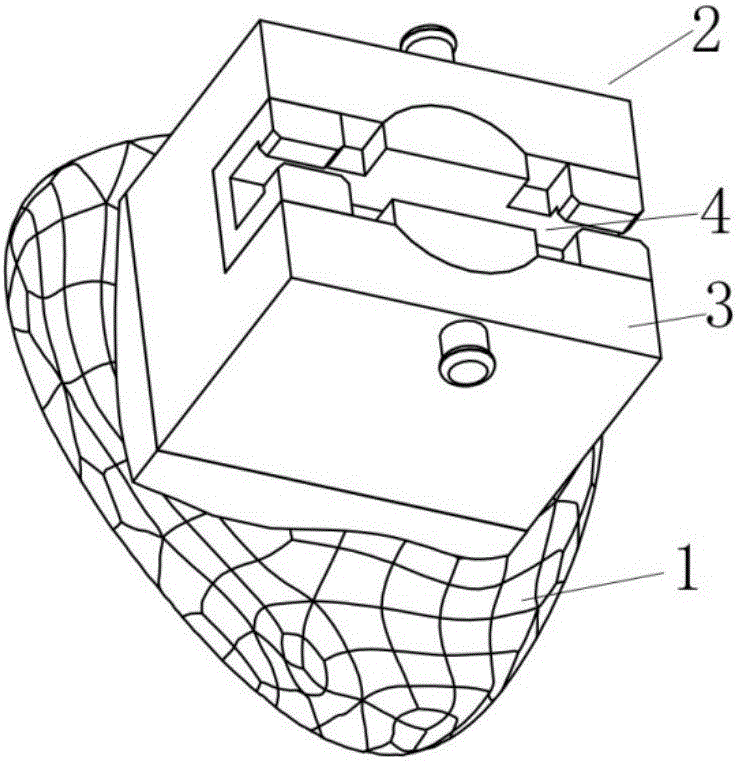 Separable orthodontic bracket