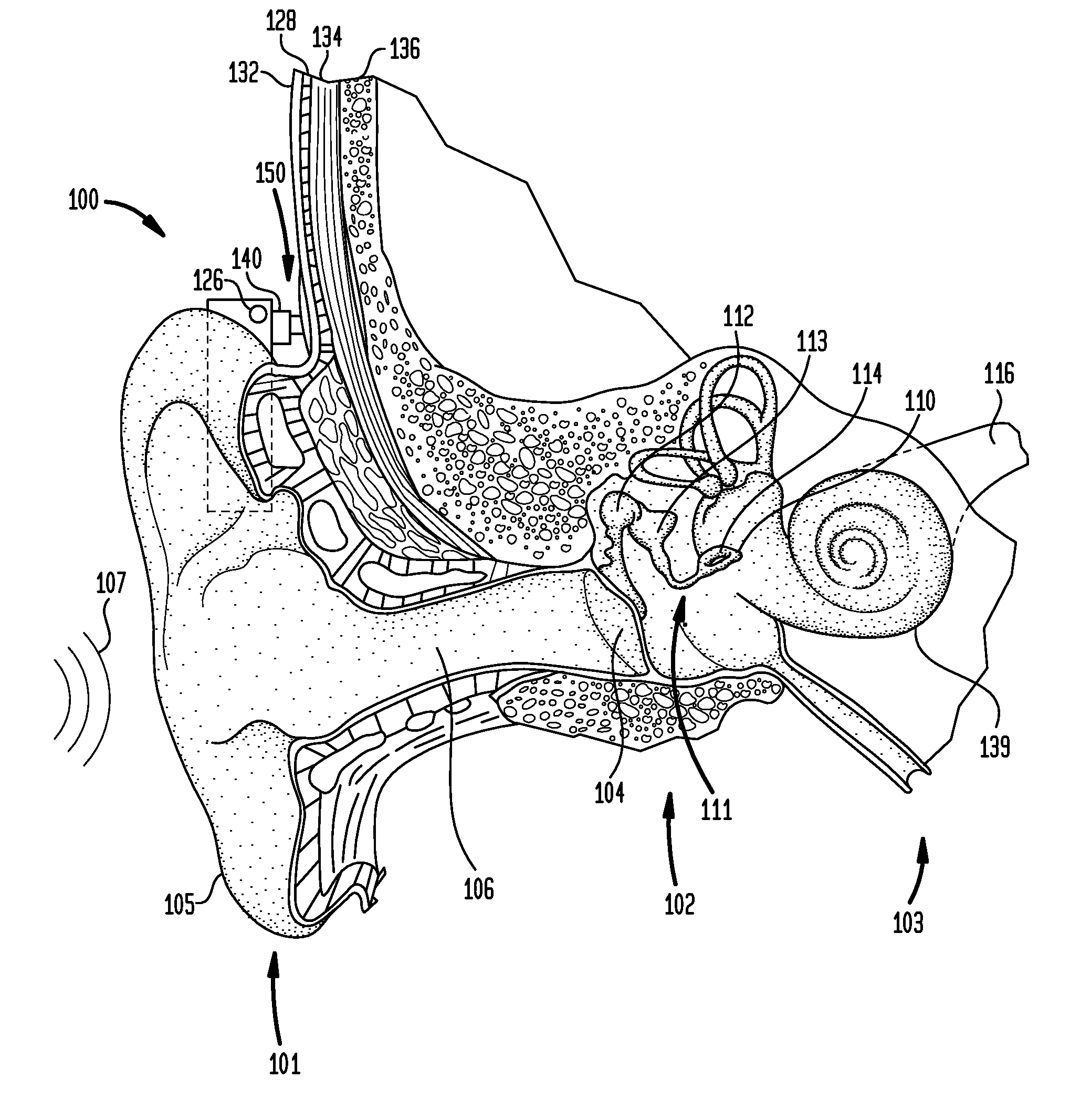 Temporary anchor for a hearing prosthesis