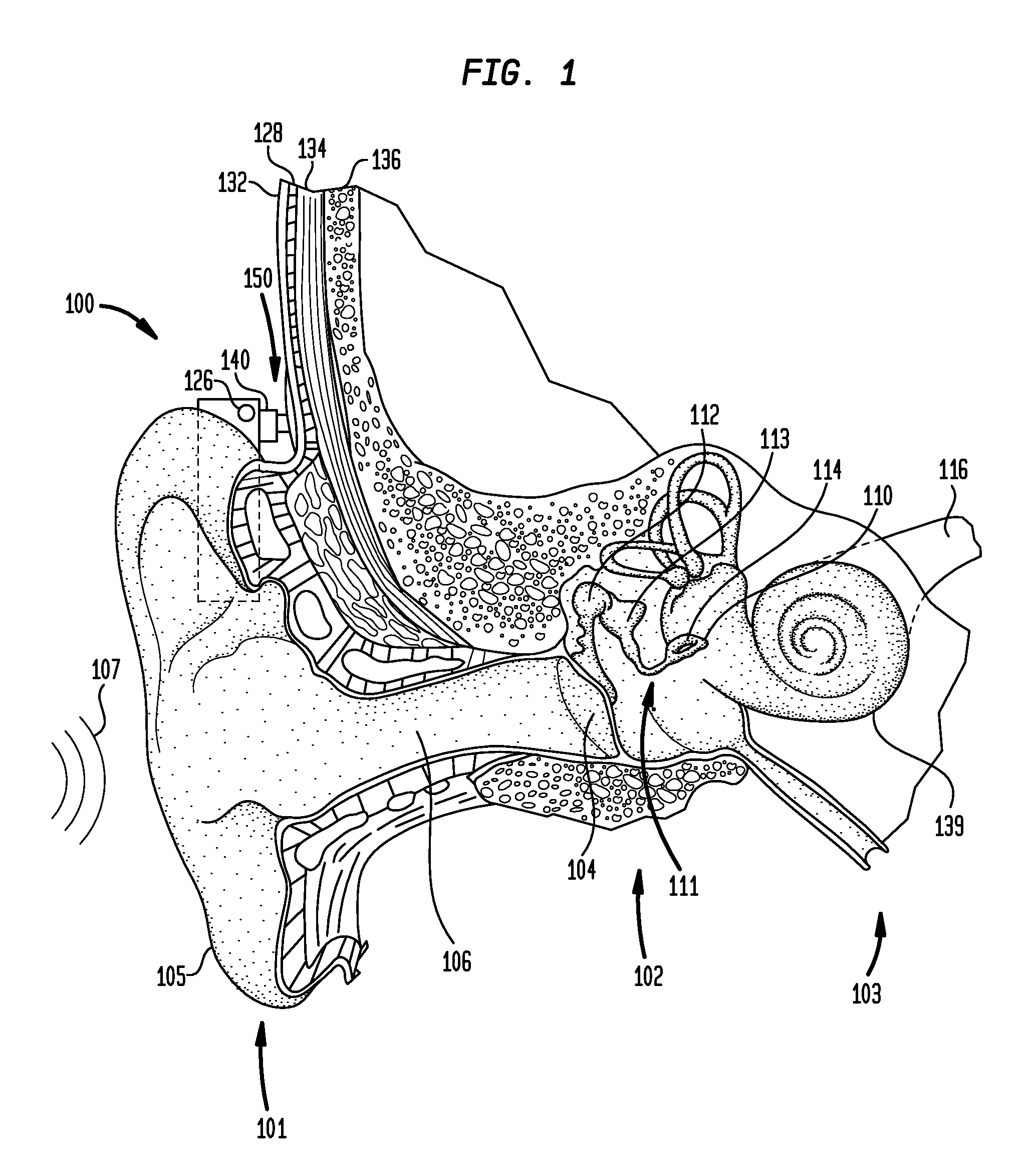 Temporary anchor for a hearing prosthesis