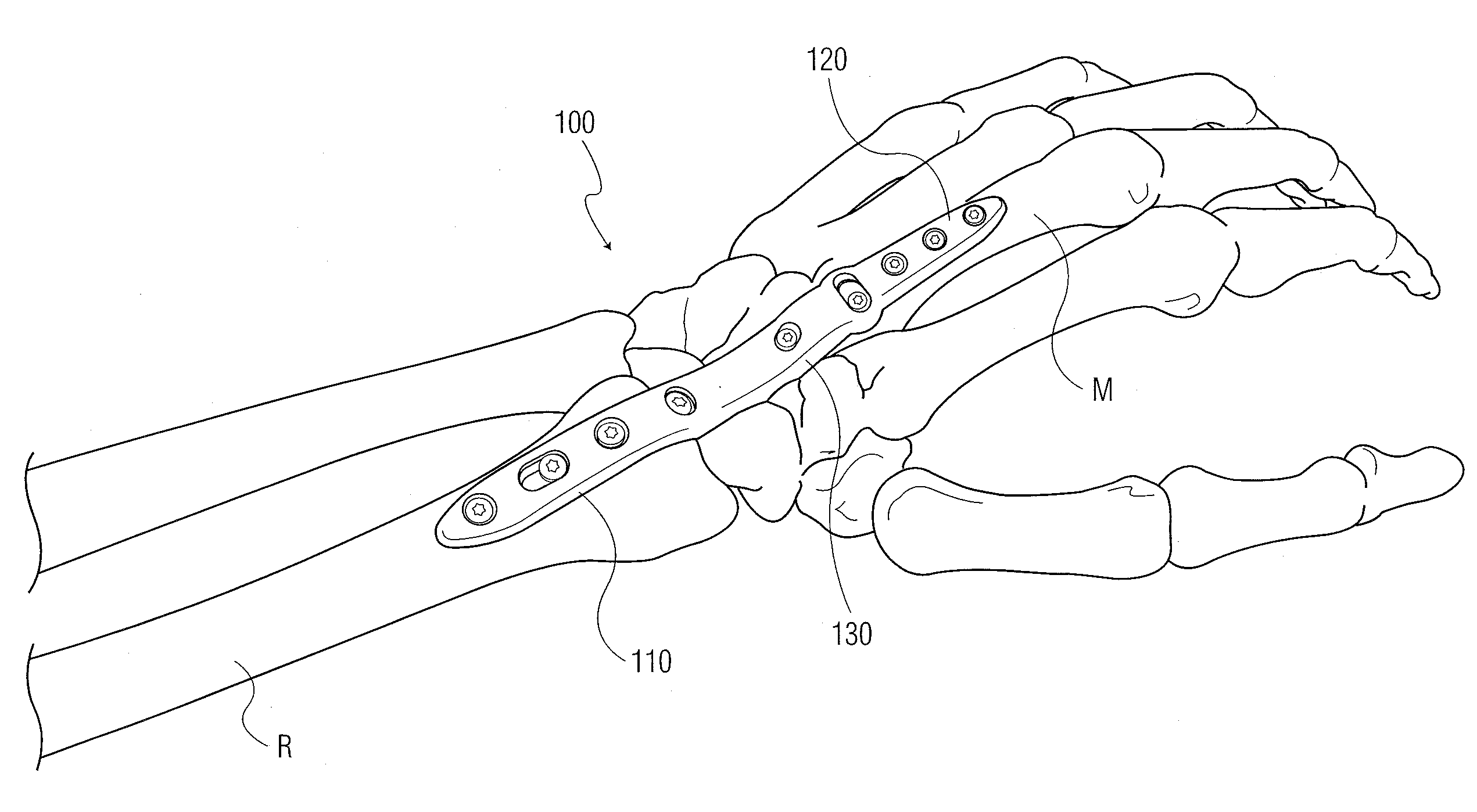 Wrist fusion plate