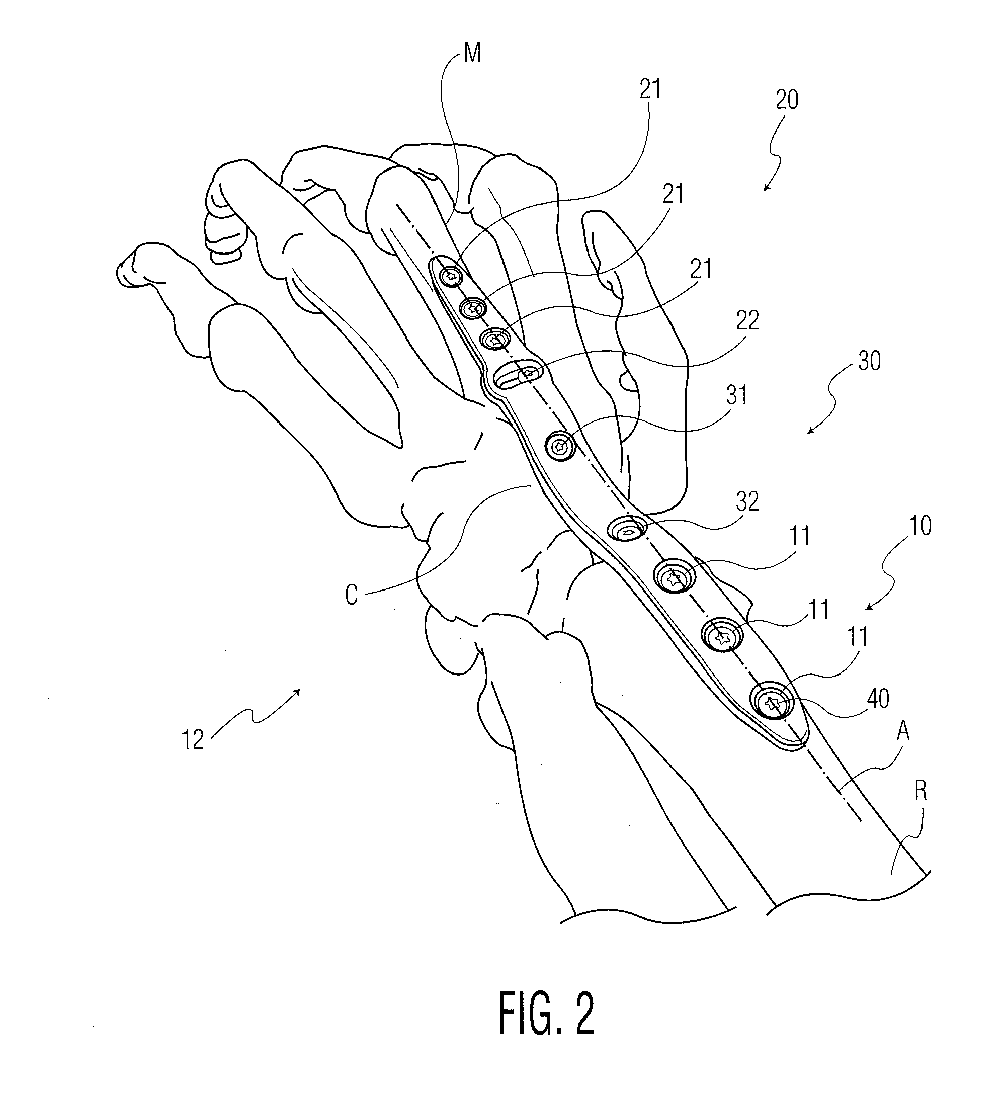 Wrist fusion plate