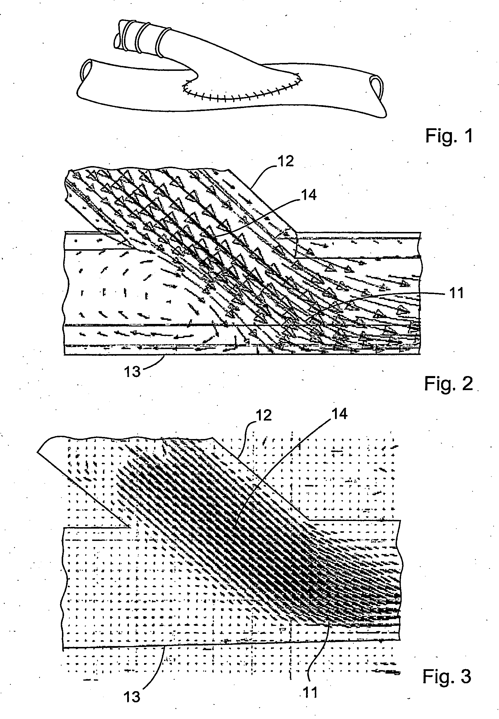 Vascular graft