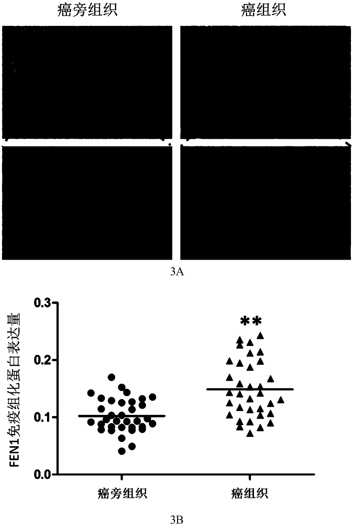 Application of reagent for detecting expression level of FEN1 gene to preparation of reagents used for diagnosing and predicting invasion and metastasis of liver cancer