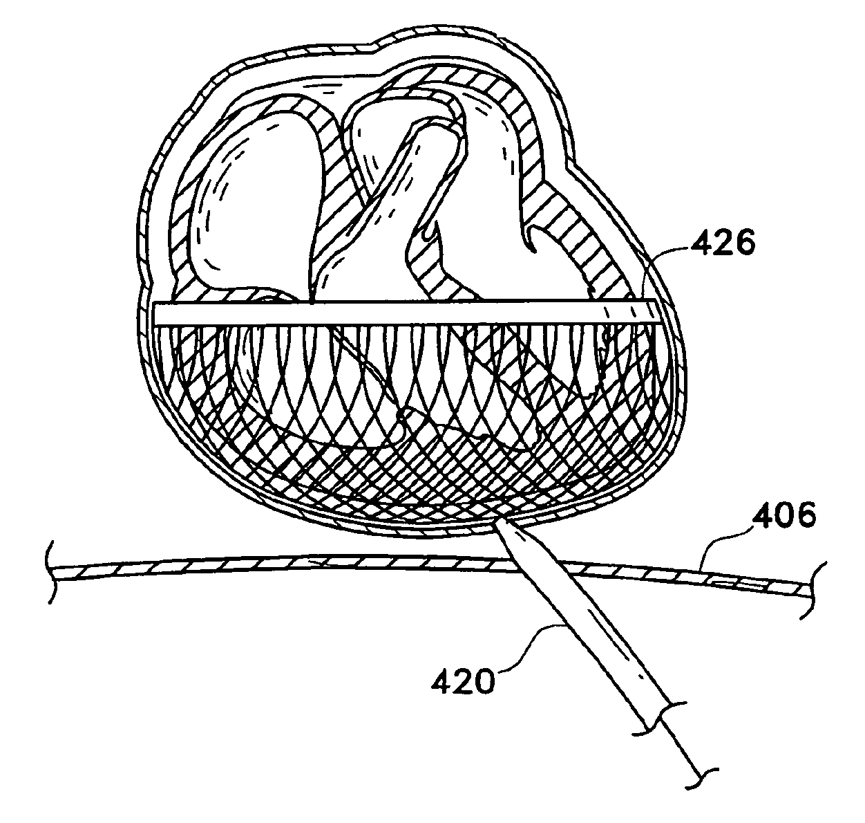 Pericardium reinforcing devices and methods of using them