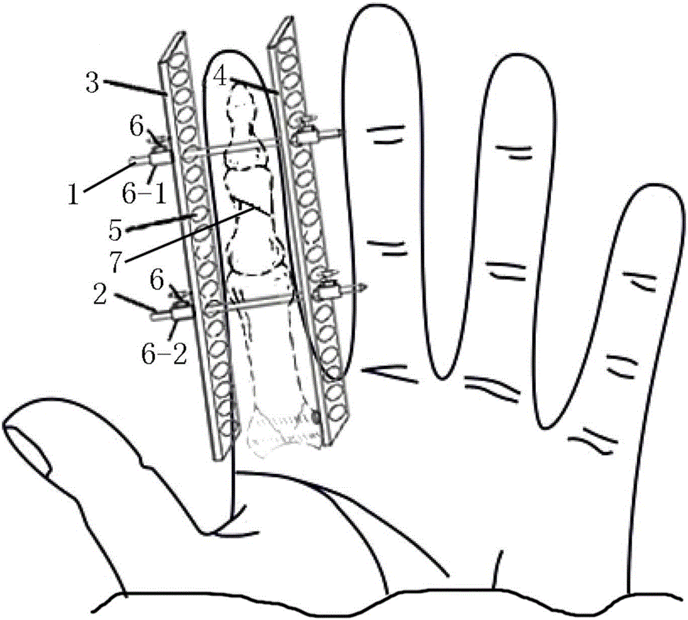 Movable bone traction device