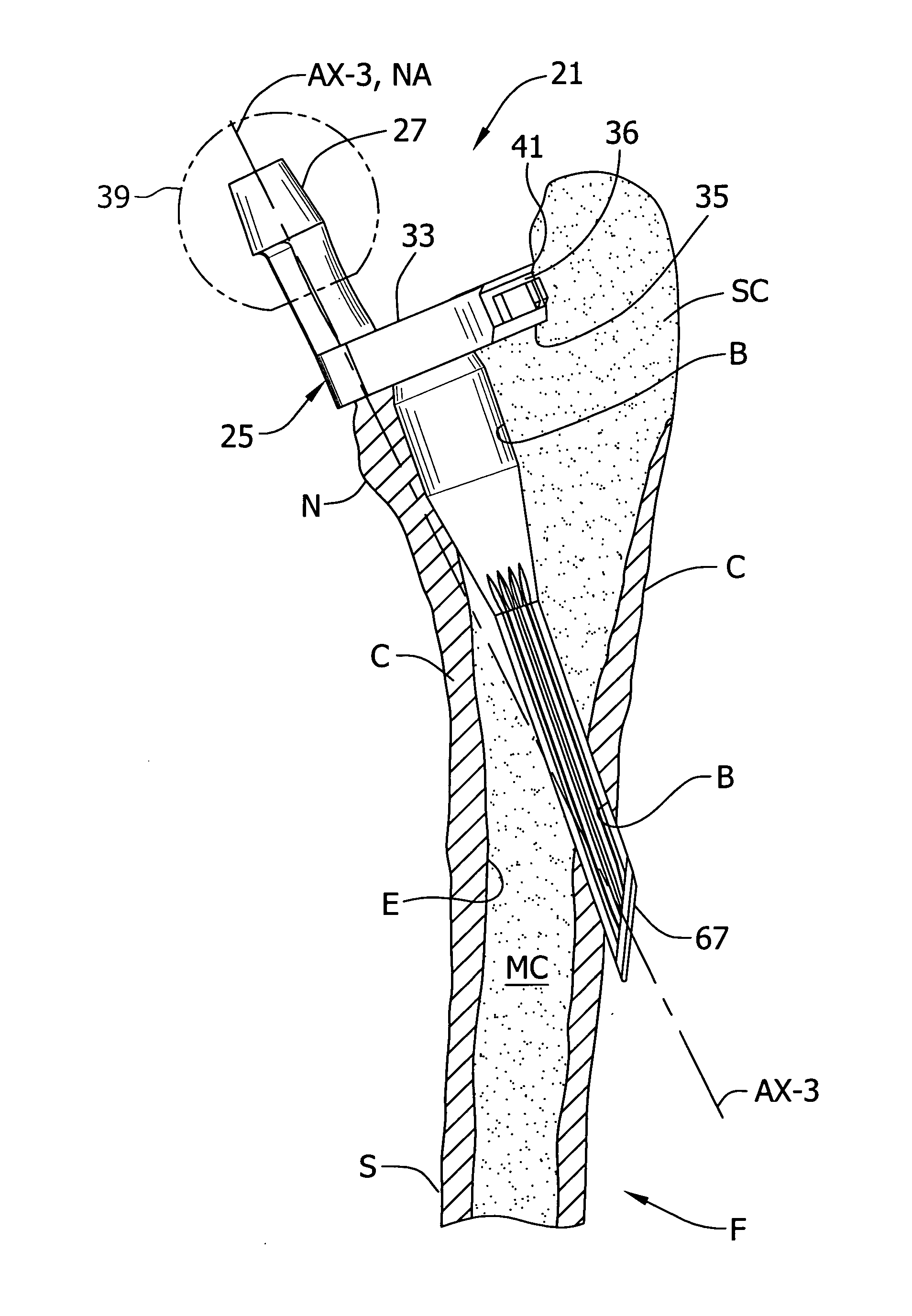 Prosthesis and method of implantation