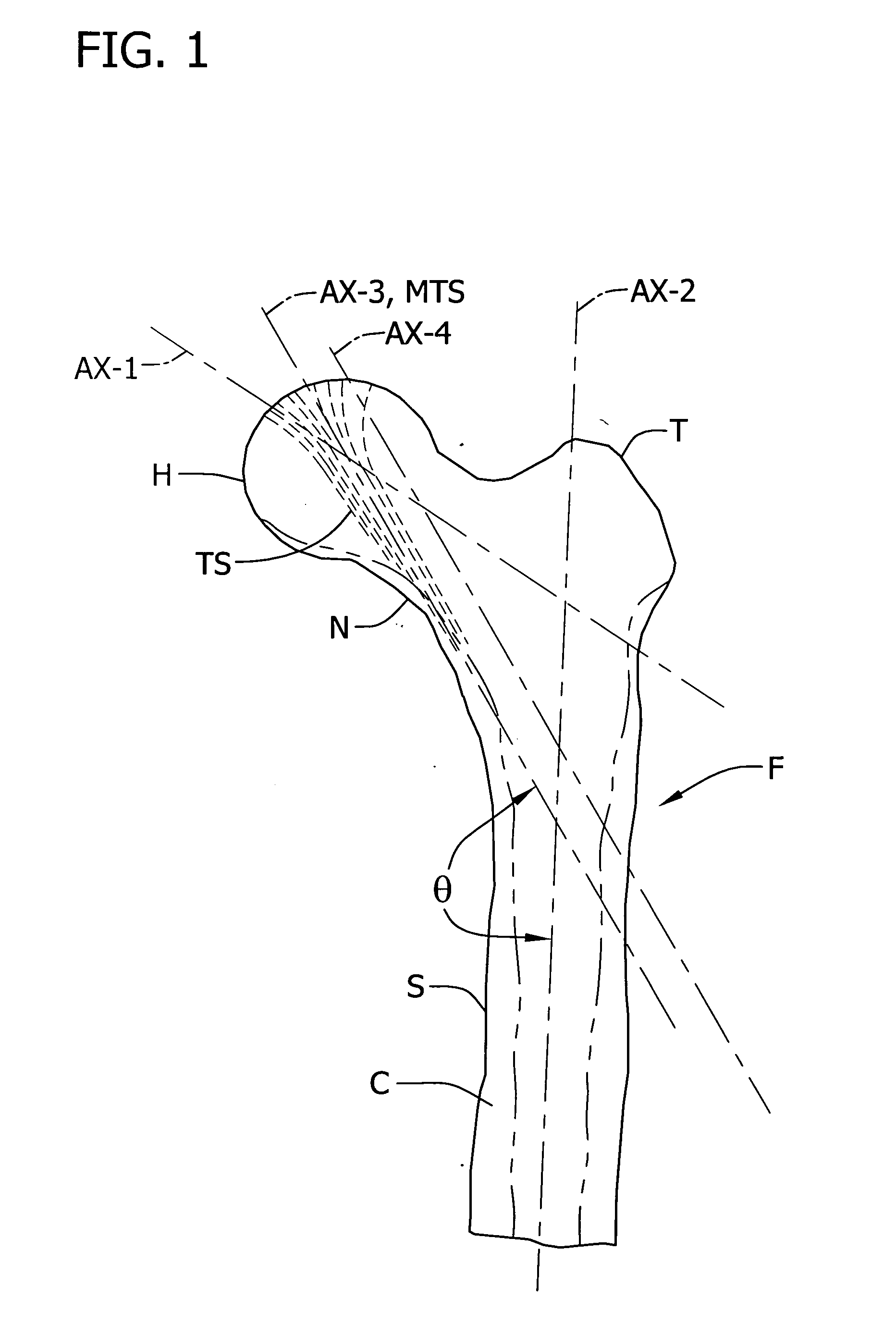 Prosthesis and method of implantation